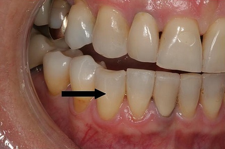 dental implant with crown dental implant with crown