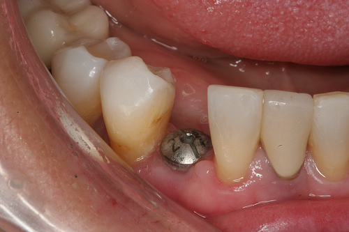 dental implant dental implant