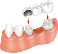 dental bridge dental bridge