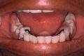 denture denture