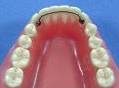 lower metal retainer