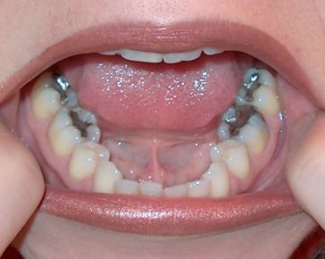 white fillings