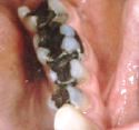 white fillings