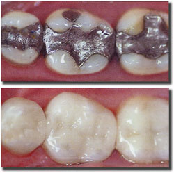 composite fillings / white fillings