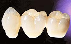3 unit dental bridge 3 unit dental bridge