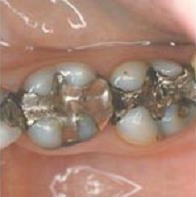 amalgam filling amalgam filling