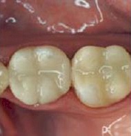 CEREC filling CEREC filling