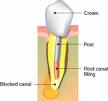 dental core