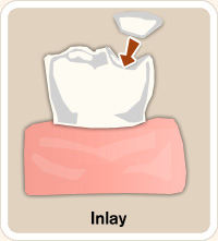 dental inlay dental inlay