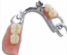 metal frame denture metal frame denture
